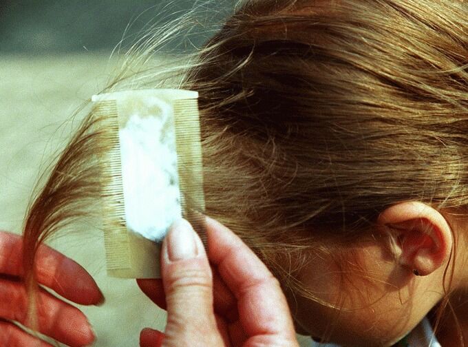 Felles sjekk er den mest effektive måten å hindre spredning av hodelus på.
 Foto: abcnyheter.no