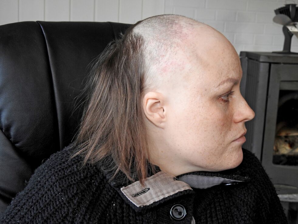 36 år gamle Bente Buskum i Lakselv har hårsykdommen Alopecia. – Man må bare leve med det, og man lærer seg å gjøre det, sier Bente, og innrømmer at det var en psykisk belastning da håret hennes begynte å falle av.
 Foto: Kristin Marie Ericsson